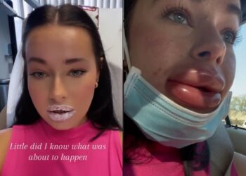 A vrut să-și facă buzele mai mari, așa că a pățit ASTA!