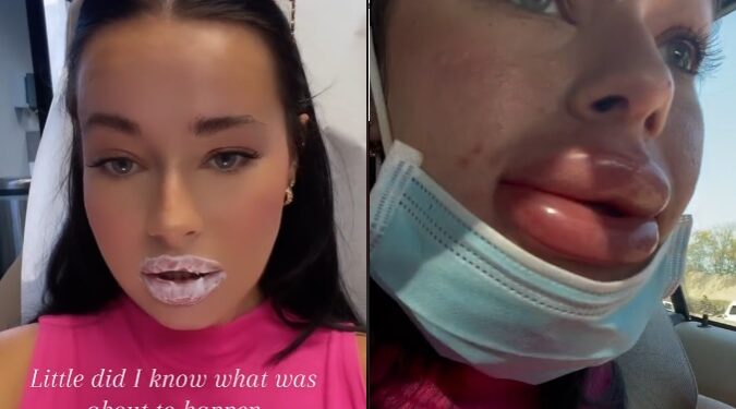 A vrut să-și facă buzele mai mari, așa că a pățit ASTA!